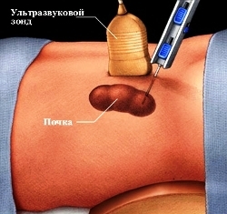 рисунок - биопсия почки