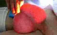 диафаноскопия мошонки - фото