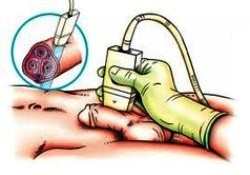 допплер пениса - рисунок