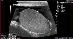 УЗИ органов мошонки - фото