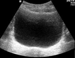 УЗИ мочевого пузыря - фото