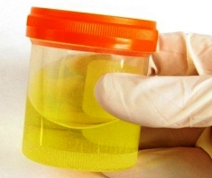 анализ мочи по Нечипоренко - фото