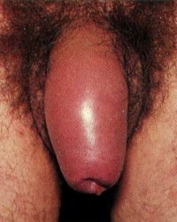 отек полового члена - фото