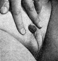 отсутствие яичек - фото