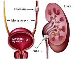 почечная колика - рисунок