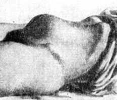 не идет моча