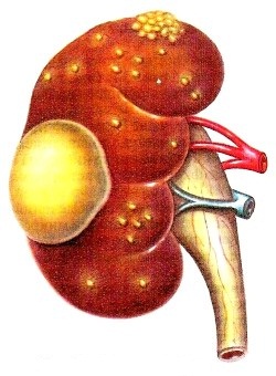 абсцесс почки - рисунок