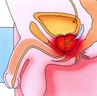 рисунок - абсцесс простаты