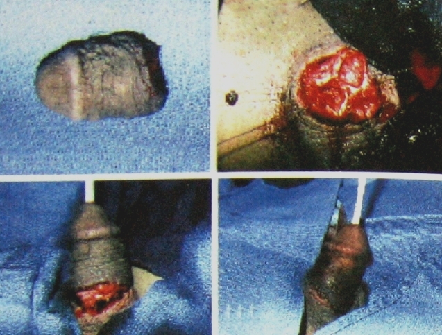 ампутация члена