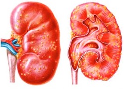 апостематозный нефрит - рисунок