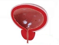 аллергический цистит - рисунок