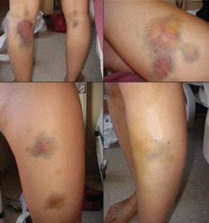 ДВС синдром