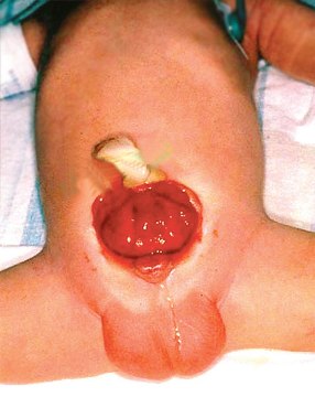 фото - экстрофия мочевого пузыря