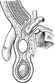 киста семенного канатика - рисунок фуникулоцеле