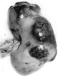 карбункул почки - фото