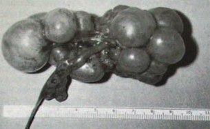 мультикистоз почки - фото