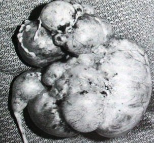 мультикистоз почки - фотография