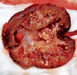 пионефроз - фото