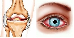 синдром Рейтера