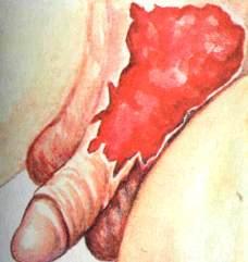 скальпированная рана члена