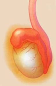 абсцесс придатка яичка - фото