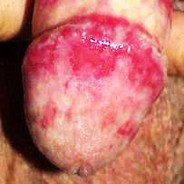 баланопостит - фото