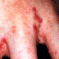 чесотка - фото