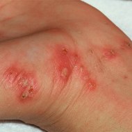 чесоточные расчесы на запястье - фото