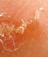 чесоточный ход - фото