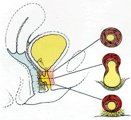 дивертикул уретры - схема