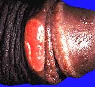 тропическая язвенная гранулема - фото