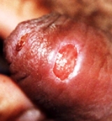венерическая гранулема - фото