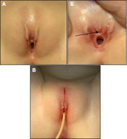 эписпадия у женщин - фото