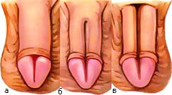 эписпадия у мужчин - фото