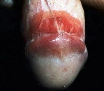 эритроплазия Кейра - фото