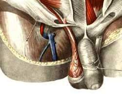 фуникулит - воспаление семенного канатика - фото