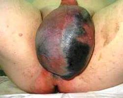 гангрена Фурнье - фото
