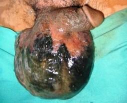 гангрена мошонки - фото