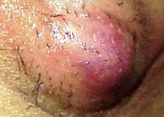 гидраденит мошонки - фото