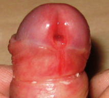 гипоспадия - фото