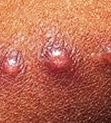 паховая гранулема - фото