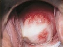 хламидиоз у женщин