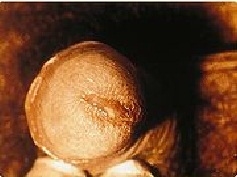 хламидиоз у мужчин