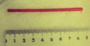 инородное тело мочевого пузыря