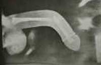 инородное тело уретры