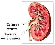 камень в почке - рисунок