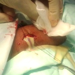 вскрытие гнойного кавернита - фотография