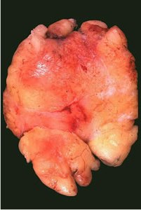 липома почки - фото