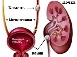 мочекаменная болезнь - рисунок