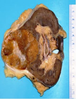 онкоцитома почки - фото